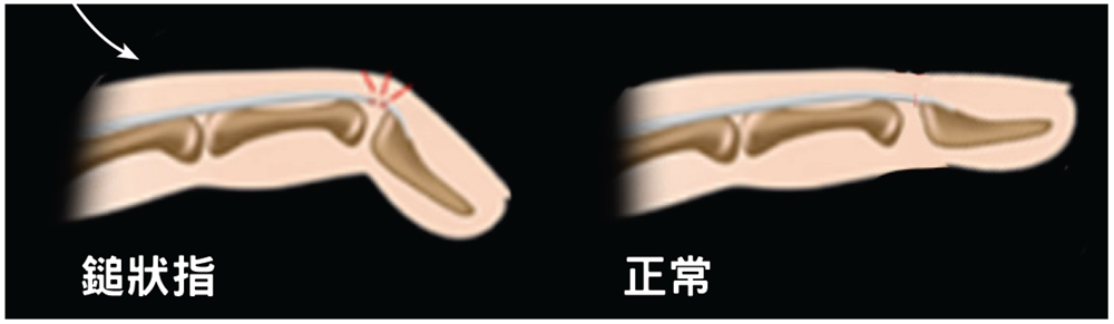 PIP osteoarthritis details